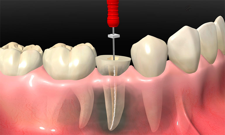Лечение пульпита трёхканального зуба - Стоматология Май