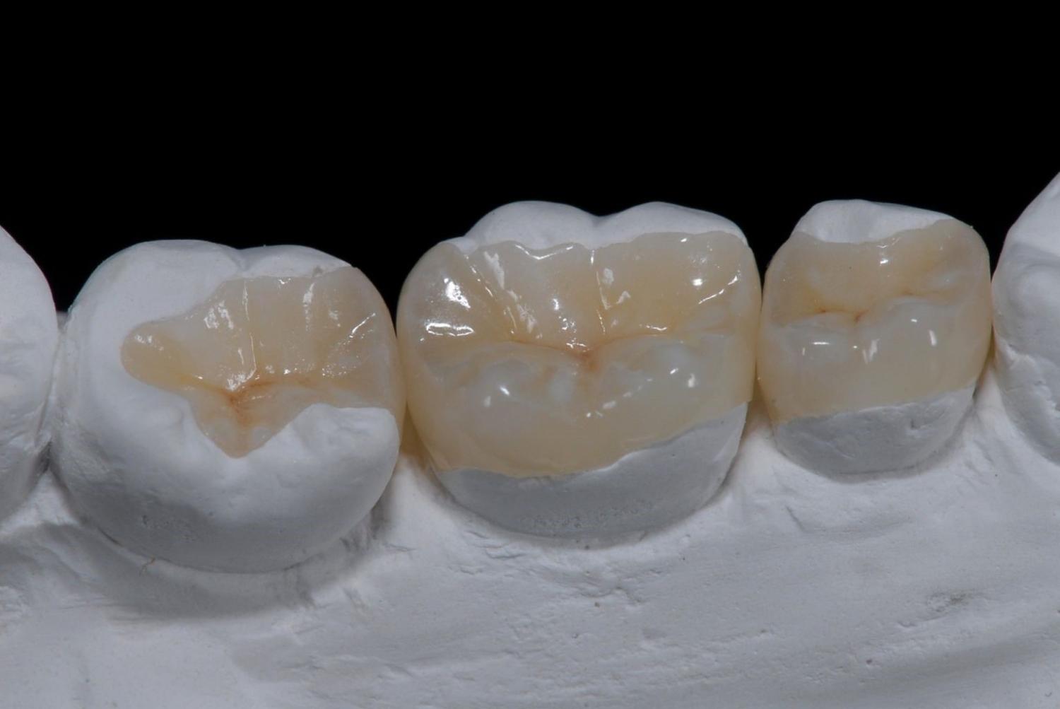 Микропротезирование зубов (вкладки)